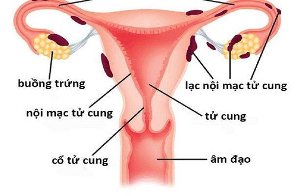 https://suckhoedoisong.qltns.mediacdn.vn/324455921873985536/2022/11/20/lac-noi-mac-tu-cung3-16689534668591353369606.jpg