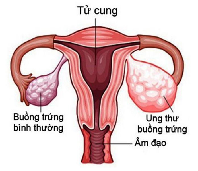 https://benhvienk.vn/data/media/1601/images/20190501_153617_041637_ung_thu_buong_trung_max-1800x1800.jpg