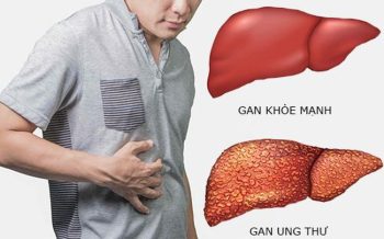 YẾU TỐ NGUY CƠ UNG THƯ GAN VÀ DỰ PHÒNG