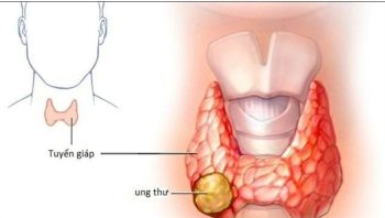 UNG THƯ TUYẾN GIÁP THỂ KHÔNG BIỆT HÓA CÓ NHỮNG BIỂU HIỆN, TRIỆU CHỨNG NHƯ THẾ NÀO?